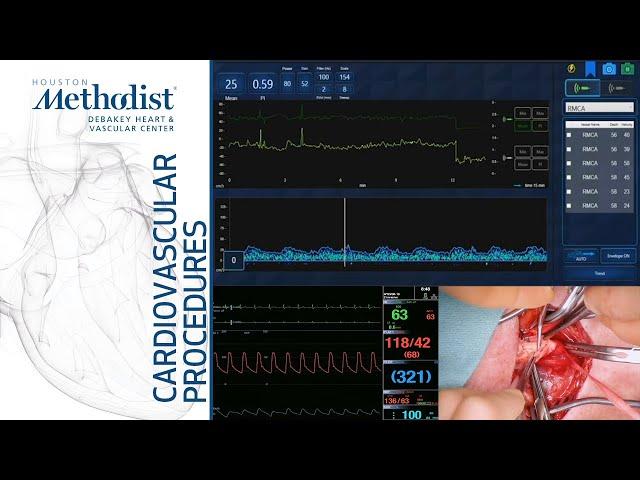 Transcranial Doppler Monitoring During CEA (Lumsden MD, Garami MD, Berczeli MD, Sinha MD, Tekula MD)