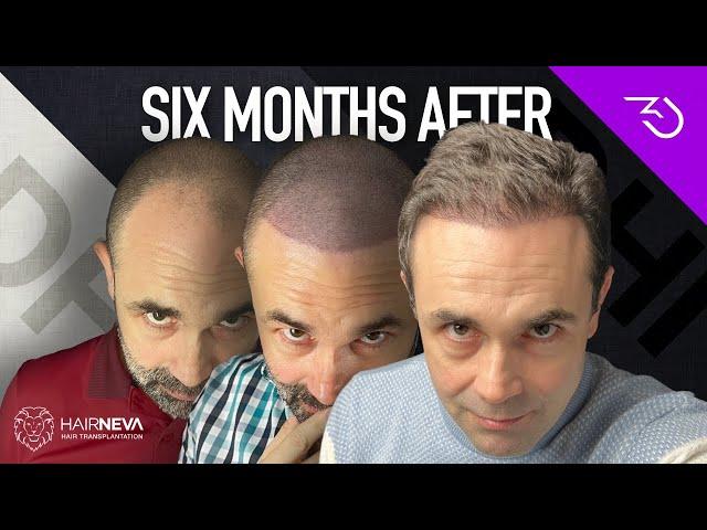 Best Hair Transplant In Turkey - DHI 6 months results