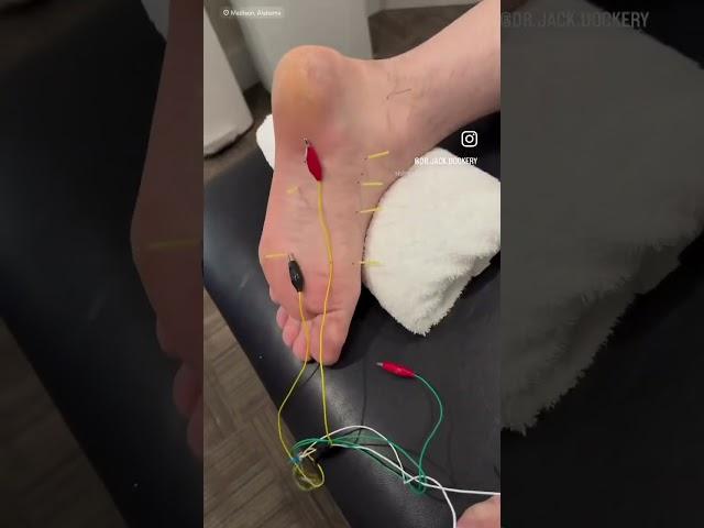 Dry Needling for #plantarfasciitis ; #plantarfasciitisrelief #footpain #dryneedling #acupuncture