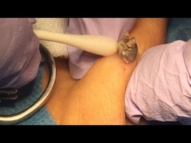 Epidermal cyst removal  - On the back