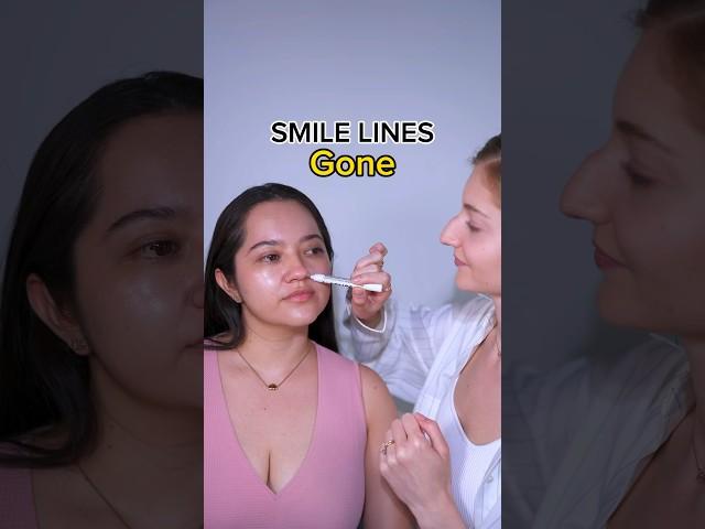 smile lines disappeared #smilelines #facemassage #faceyoga #faceexercises #facefitness