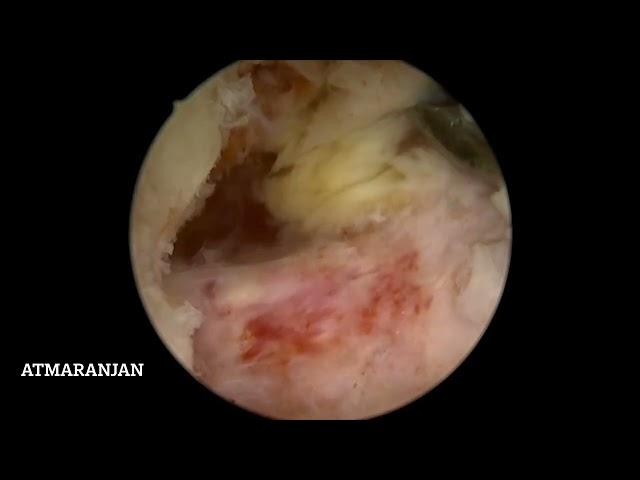 Revision lumbar canal stenosis   by endoscopic biportal spine endoscopy/ube. Dr Atmaranjan Dash