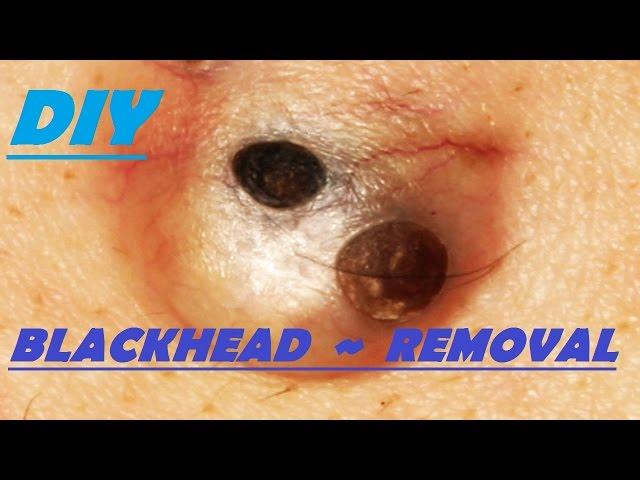 DIY blackhead removal