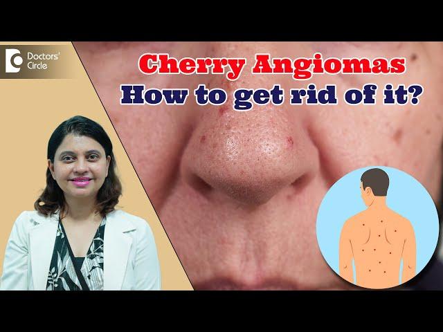 RED DOTS ON SKIN | Cherry Angioma & its Treatment | Red Moles - Dr. Amee Daxini | Doctors' Circle