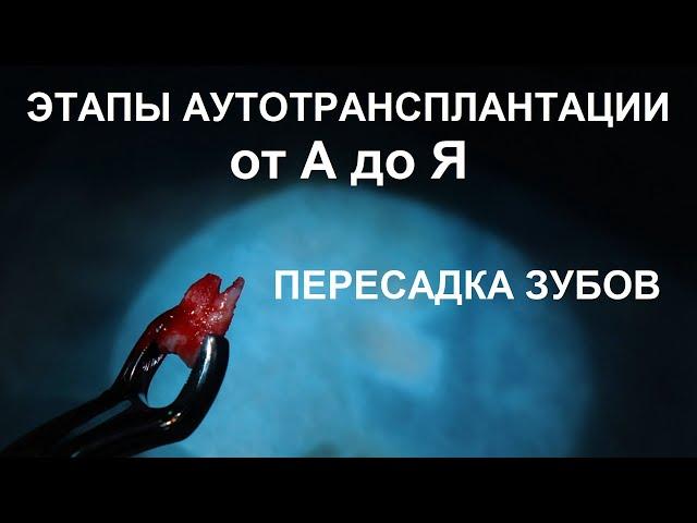 Этапы аутотрансплантации зуба: два удаления, одна припасовка и одна имплантация