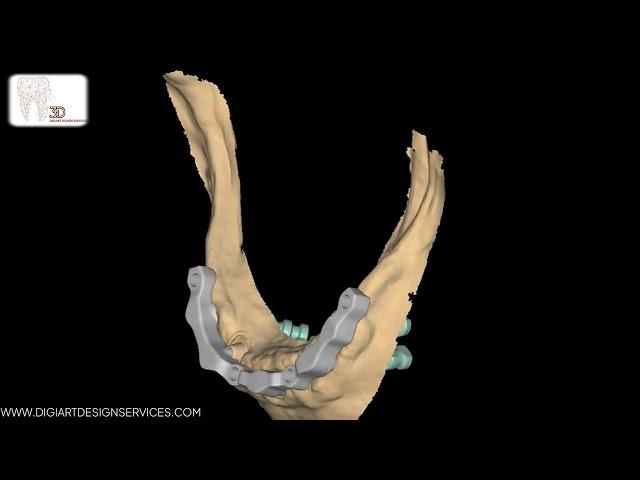 Mastering Dental Bar Design with Telescopic Attachments in Exocad