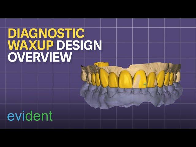 Diagnostic Waxup Design Overview with Exocad| Evident Digital | Dental CAD Design