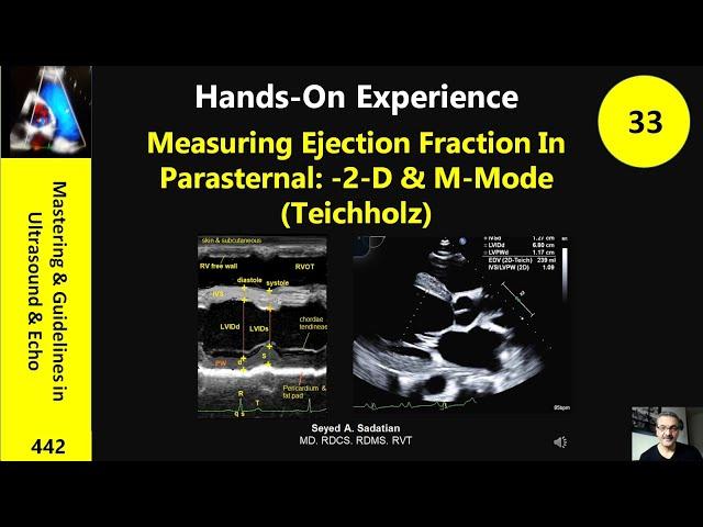 Measuring Ejection Fraction In Parasternal: -2-D & M-Mode (Teichholz)