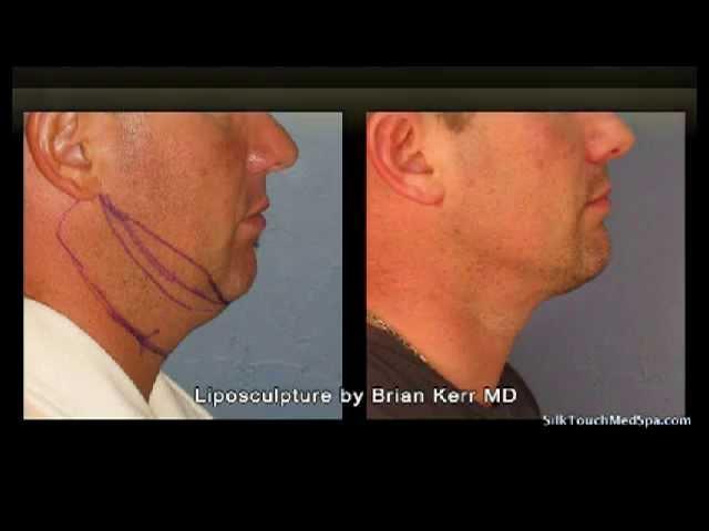 Liposuction Before and After of Neck Area | Silk Touch Medical Aesthetics, Boise