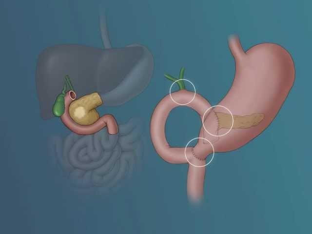 The Whipple Procedure | Johns Hopkins Medicine