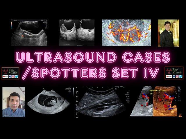 ULTRASOUND SPOTTERS AND CASES SET IV