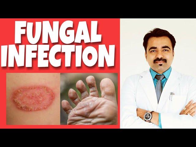 FUNGAL INFECTIONS Types, Symptoms, treatment (HINDI)