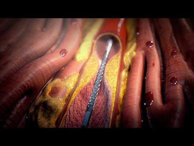 Stent Procedure