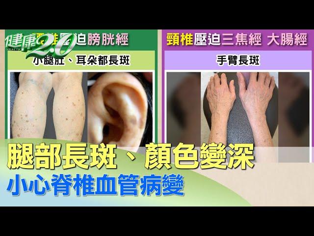 腿部長斑、顏色變深 小心脊椎血管病變 健康2.0