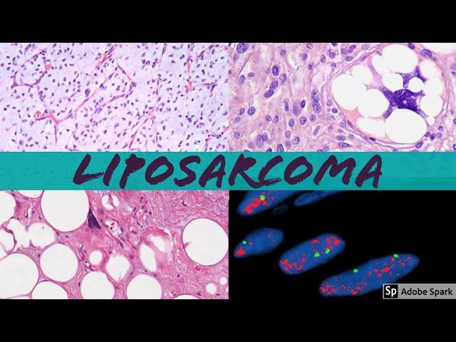 Liposarcoma 101: Everything a Pathologist Needs to Know