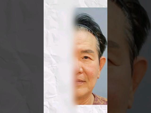 ‍️이마거상 왜 고민하세요..? #강남성형외과 #논현성형외과 #plasticsurgerykorea #이마거상 #lifting #안면거상