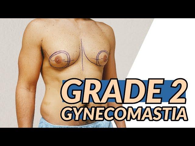 Grade 2 Gynecomastia Surgery with Dr. Dadvand