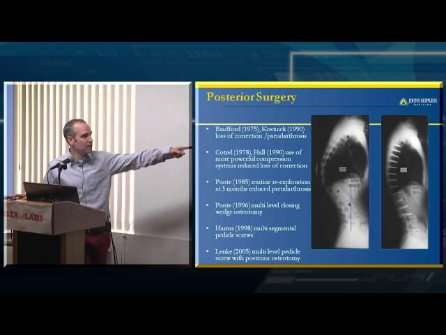 Scheuermanns's Disease (Kyphosis)