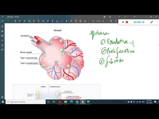 Acute respiratory distress syndrome || Medicine