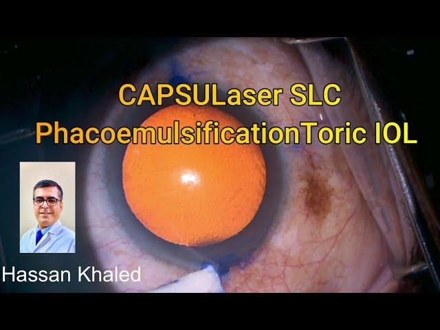 CAPSULaser SLC , PhacoemulsificationToric IOL