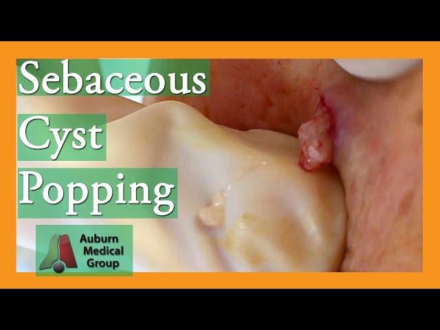 Epidermoid Cyst Popping #popping | Auburn Medical Group