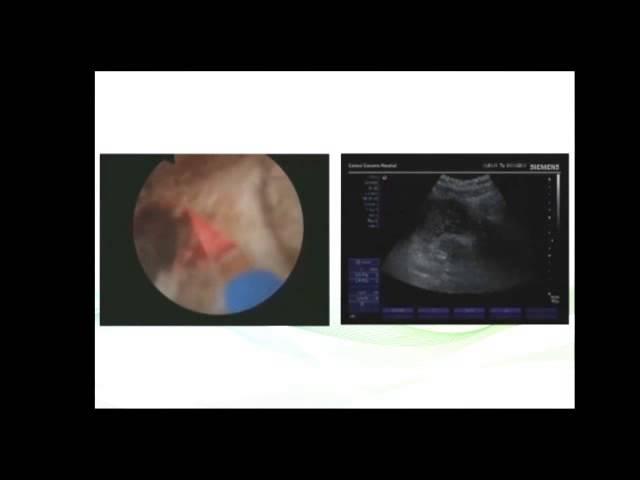 Thulium laser prostate surgery with ultrasound guidance (180cc) Dr. Farid Gadimaliyev