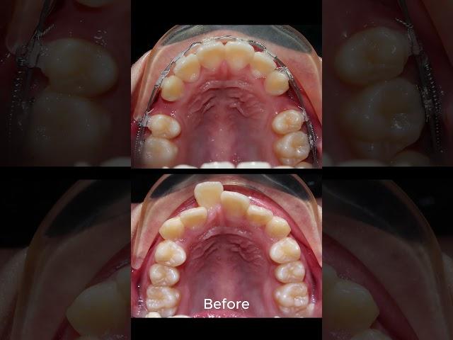 Braces proces - tooth extraction fix overbite teeth