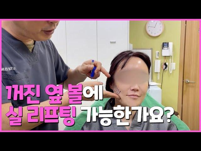 꺼진 옆볼도 실리프팅으로 개선이 가능할까요?