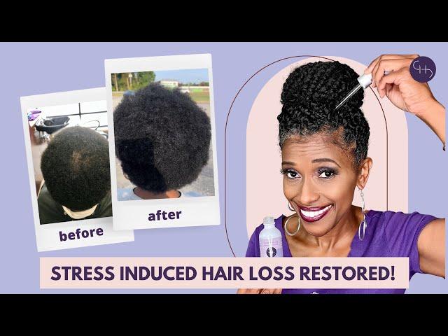 Hair Loss RESTORED After Stress