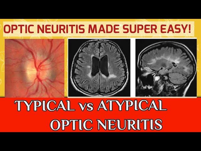 OPTIC NEURITIS || Typical optic neuritis and atypical optic neuritis