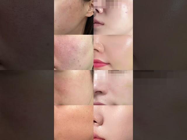 스킨부스터 끝판왕 줄기세포피부주사 효과 비교