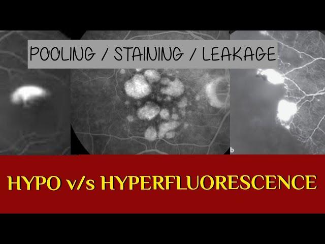 FFA COURSE || HYPERFLUORESCENCE V/S HYPO-FLUORESCENCE on FFA