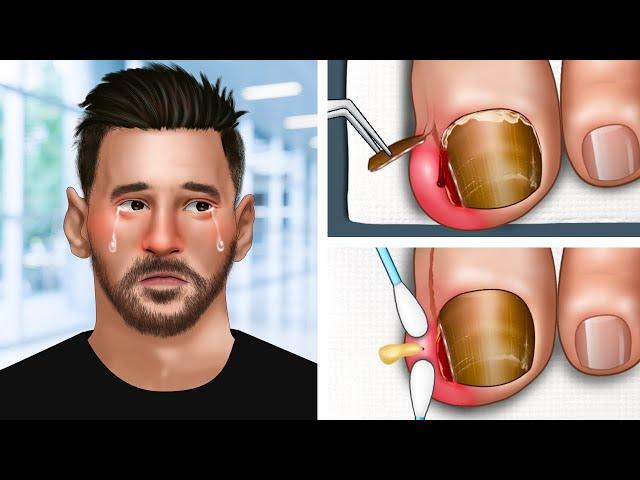 [ASMR Animation] Help Messi remove ingrown toenail | ingrown toenail removal, foot cleaning