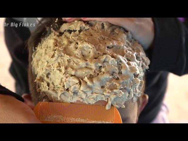 Scratching Itchy Psoriasis On Scalp !! Dandruff Removal Big Flakes Satisfying#343