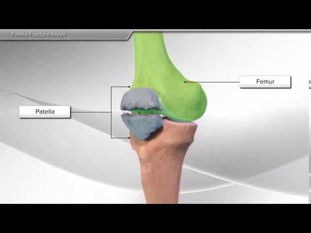 Перелом надколенника: операция