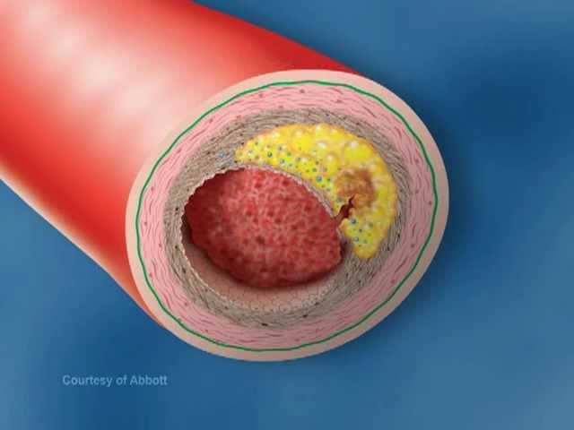 Vulnerable Plaque Rupture - Medical Animation by Watermark