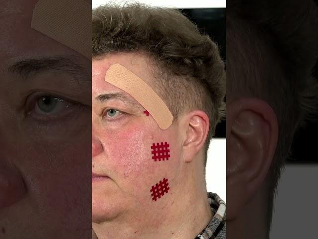 Кросстейпирование лицевых нервов. Ведущий эксперт BBalance Сания Абдрахманова.