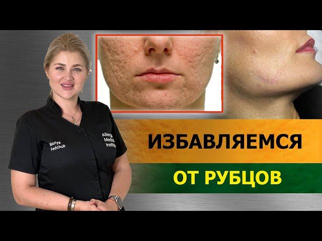 РУБЦЫ и ПОСТАКНЕ. Как убрать ШРАМЫ от прыщей на лице?