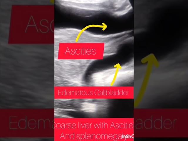 Case of coarse liver |Ascites|splenomegaly|ultrasound