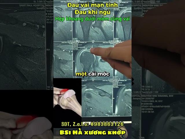 Đau Vai Mãn Tính Khi Ngủ – Cảnh Báo Hẹp Khoang Dưới Mỏm Cùng Vai!