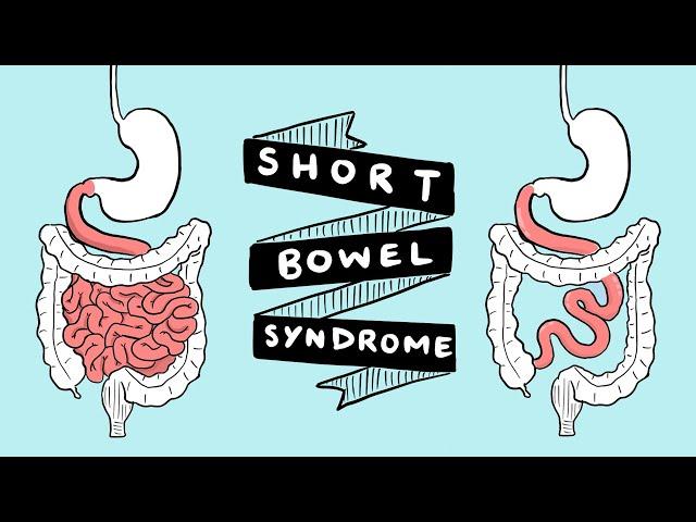 Short Bowel Syndrome Symptoms and Complications | What is SBS? | GI Society