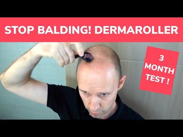 STOP BALDING! - Dermaroller 3 Month Test and Tutorial