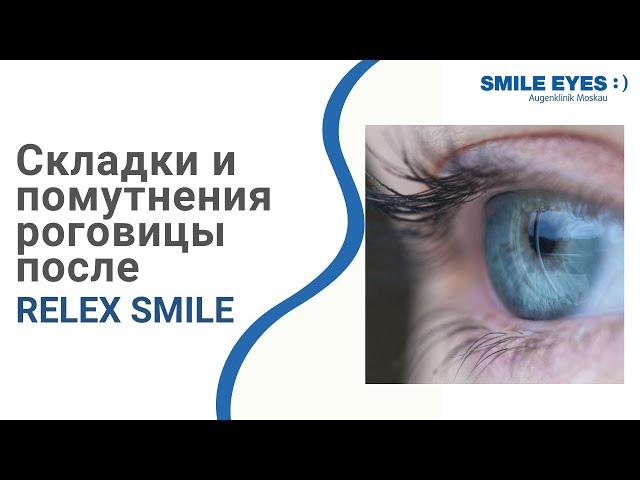 Складки и помутнения роговицы после лазерной коррекции Смайл (ReLEx SMILE)