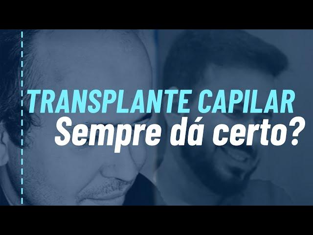 O Transplante  de cabelo sempre funciona?