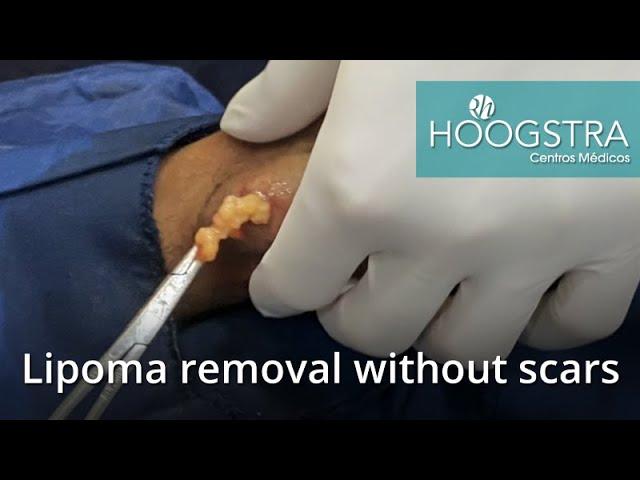 Lipoma removal without scars (20204)