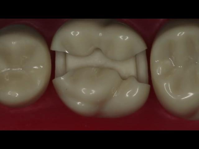 Class II Amalgam Preparation #14 MOD | Amalgam Preparation Technique