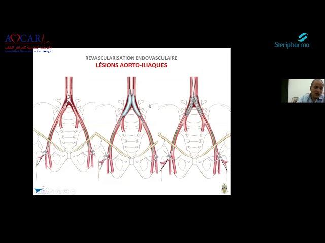 Vidéo Intégrale « Pathologie Vasculaire »