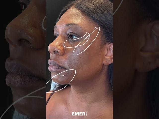 UNLEASHING THAT FEMININE LOOK WITH FACIAL SCULPTING #shorts #fillers  Dr. Jason Emer