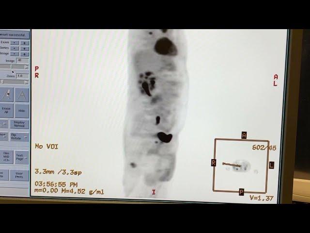 PET Scan Machine Detecting Cancer
