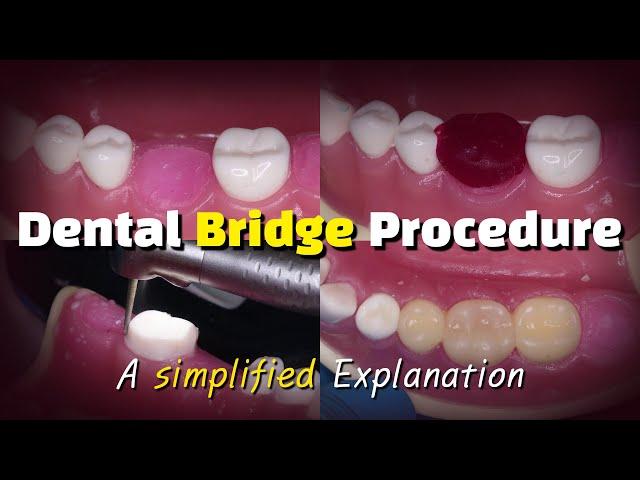 Dental Bridge Procedure